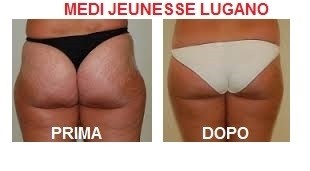 Foto medilipo culotte de cheval - MEDI JEUNESSE CLINIC