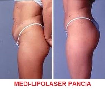 Foto medilipo pancia - MEDI JEUNESSE CLINIC