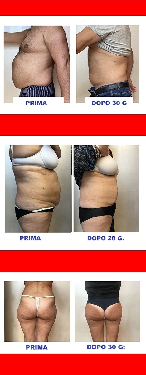 Foto prima e dopo - MEDI JEUNESSE CLINIC